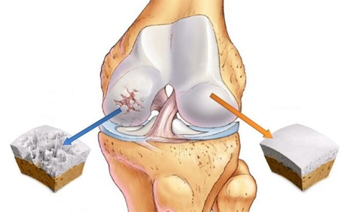Healthy knee cartilage and arthropathy