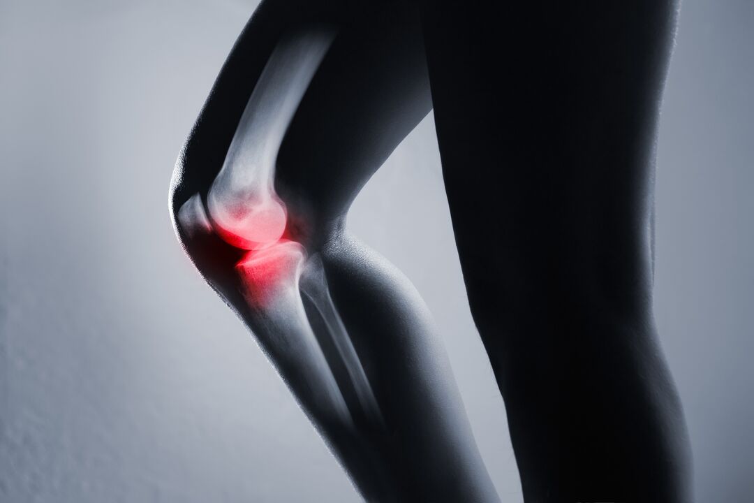 Knee joint inflammation with arthropathy