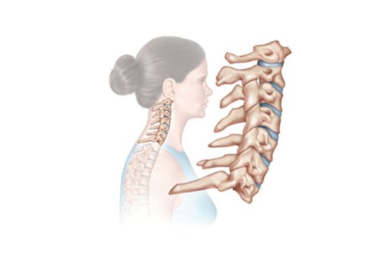 The damage of osteochondrosis to the cervical spine