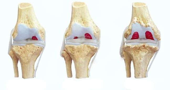 Stages of knee osteoarthritis