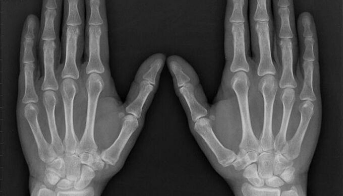 X-rays for diagnosing arthritis and joint disease