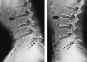 thoracic osteochondrosis vertebral displacement