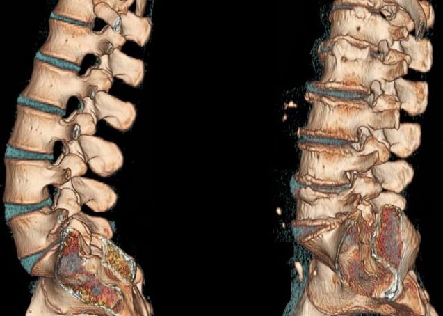 Osteochondral disease in the waist