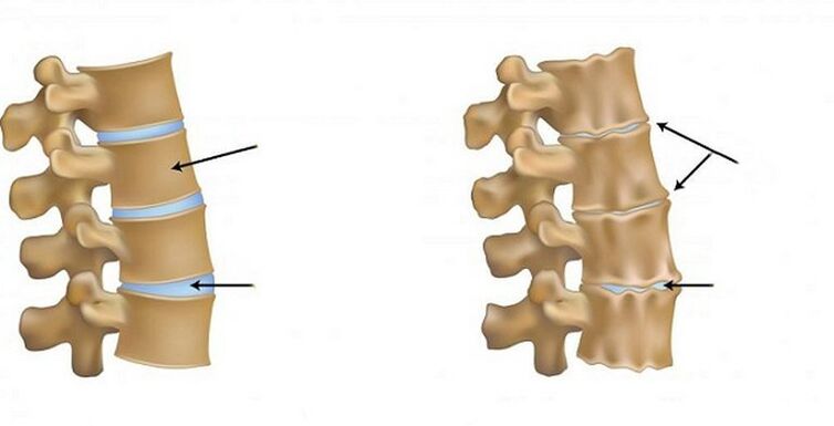 Osteochondrosis ischemic syndrome