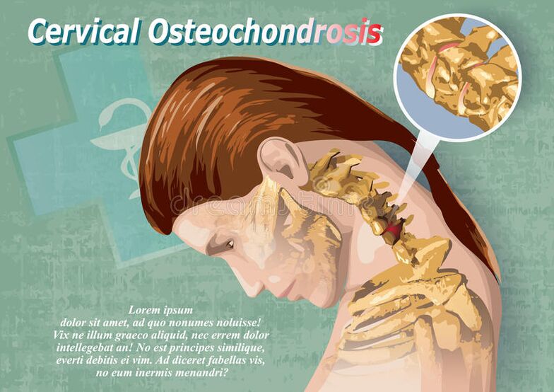 Neck bone and chondropathy is a disease of cartilage tissue
