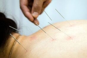 Acupuncture treatment of osteochondrosis