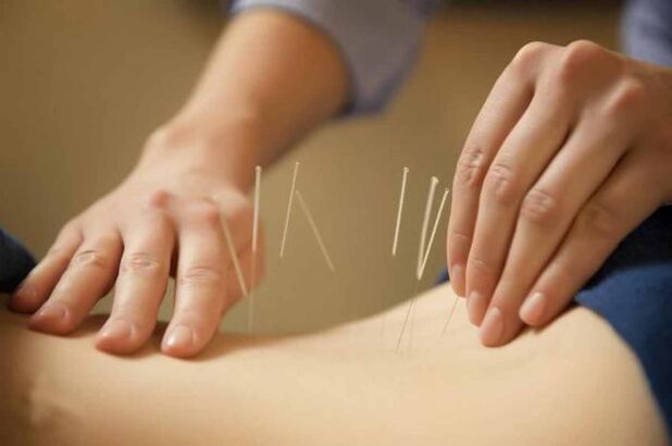 Acupuncture treatment of osteochondrosis