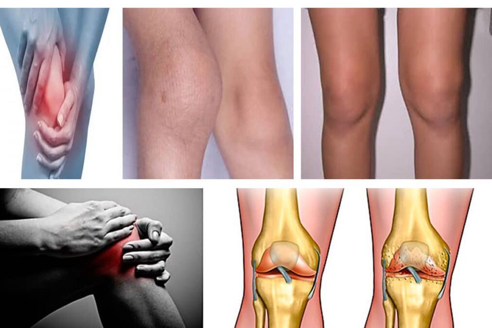 Symptoms of knee joint disease