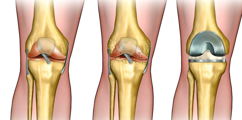 knee arthritis