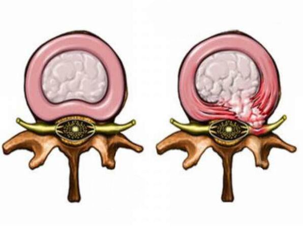 Healthy and Unhealthy Intervertebral Discs